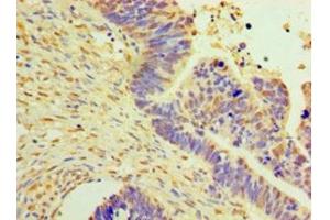 Immunohistochemistry of paraffin-embedded human ovarian cancer using ABIN7150514 at dilution of 1:100 (DNAJB2 anticorps  (AA 2-324))