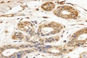 Immunohistochemistry analysis of paraffin-embedded human breast cancer using TPPP3 (ABIN7076047) at dilution of 1: 3000 (TPPP3 anticorps)