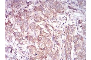 Immunohistochemical analysis of paraffin-embedded bladder cancer tissues using ARF1 mouse mAb with DAB staining. (ARF1 anticorps  (AA 76-182))