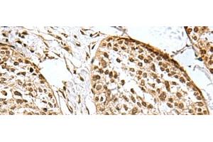 Immunohistochemistry of paraffin-embedded Human esophagus cancer tissue using H2AFJ Polyclonal Antibody at dilution of 1:170(x200) (H2AFJ anticorps)