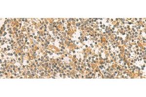 Immunohistochemistry of paraffin-embedded Human tonsil tissue using PPM1M Polyclonal Antibody at dilution of 1:100(x200) (PPM1M anticorps)