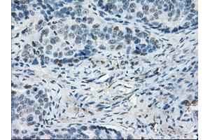 Immunohistochemical staining of paraffin-embedded Adenocarcinoma of colon tissue using anti-LTA4H mouse monoclonal antibody. (LTA4H anticorps)