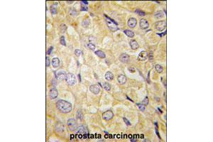 Formalin-fixed and paraffin-embedded human prostate carcinoma tissue reacted with FZD1 polyclonal antibody  , which was peroxidase-conjugated to the secondary antibody, followed by DAB staining. (FZD1 anticorps  (Internal Region))