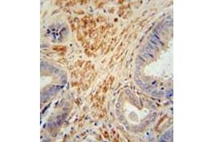 Immunohistochemistry analysis in formalin fixed and paraffin embedded human prostate carcinoma reacted with FSTL1 Antibody (C-term) followed by peroxidase conjugation of the secondary antibody and DAB staining. (FSTL1 anticorps  (C-Term))