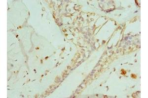 Immunohistochemistry of paraffin-embedded human breast cancer using ABIN7151371 at dilution of 1:100