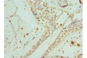 Immunohistochemistry of paraffin-embedded human breast cancer using ABIN7151371 at dilution of 1:100