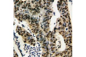 Anti-TNFAIP1 antibody, IHC(P) IHC(P): Human Rectal Cancer Tissue (TNFAIP1 anticorps  (N-Term))