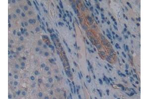 Detection of AQP1 in Human Liver cancer Tissue using Polyclonal Antibody to Aquaporin 1 (AQP1)