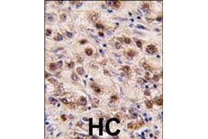 Formalin-fixed and paraffin-embedded human hepatocarcinoma tissue reacted with MINA (C-term) (ABIN387880 and ABIN2844089) , which was peroxidase-conjugated to the secondary antibody, followed by DAB staining. (MINA anticorps  (C-Term))