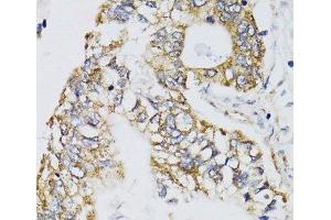 Immunohistochemistry of paraffin-embedded Human gastric cancer using CHN1 Polyclonal Antibody at dilution of 1:100 (40x lens). (CHN1 anticorps)