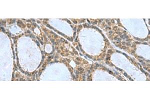 Immunohistochemistry of paraffin-embedded Human thyroid cancer tissue using CNTN4 Polyclonal Antibody at dilution of 1:65(x200) (Contactin 4 anticorps)