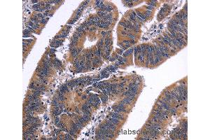 Immunohistochemistry of Human liver cancer using NFATC3 Polyclonal Antibody at dilution of 1:50 (NFATC3 anticorps)