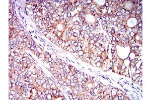 Immunohistochemical analysis of paraffin-embedded cervical cancer tissues using CD102 mouse mAb with DAB staining. (ICAM2 anticorps  (AA 25-223))