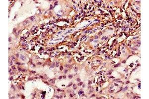 Immunohistochemistry of paraffin-embedded human lung cancer using ABIN7142110 at dilution of 1:100 (HPGD anticorps  (AA 14-130))