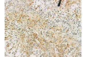 ABIN6263601 and ABIN6276613 at 1/100 staining human gastric carcinoma by IHC-P. (NET1 anticorps  (C-Term))