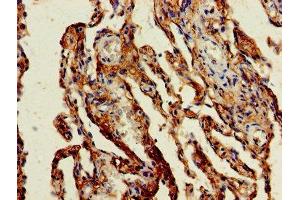 Immunohistochemistry of paraffin-embedded human lung cancer using ABIN7154472 at dilution of 1:100 (GADD45G anticorps  (AA 1-159))