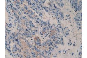 Detection of CD26 in Human Breast cancer Tissue using Polyclonal Antibody to Cluster Of Differentiation 26 (CD26)