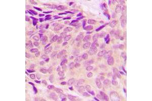 Immunohistochemical analysis of RPL37A staining in human breast cancer formalin fixed paraffin embedded tissue section.