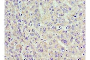 Immunohistochemistry of paraffin-embedded human liver cancer using ABIN7142321 at dilution of 1:100 (ACAA1 anticorps  (AA 27-300))