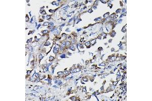Immunohistochemistry of paraffin-embedded human lung cancer using GSTK1 Rabbit pAb (ABIN1680136, ABIN3019398, ABIN3019399 and ABIN6220875) at dilution of 1:25 (40x lens). (GSTK1 anticorps  (AA 1-226))
