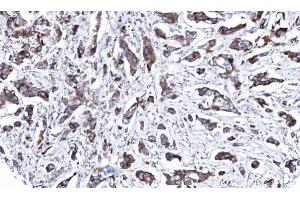 IHC-P Image Immunohistochemical analysis of paraffin-embedded human breast cancer, using MAP2K2, antibody at 1:100 dilution. (MEK2 anticorps)