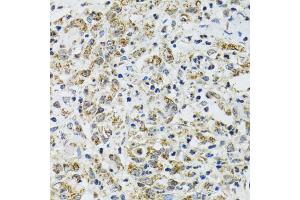Immunohistochemistry of paraffin-embedded human uterine cancer using TXN2 antibody (ABIN2560616) at dilution of 1:100 (40x lens). (TXN2 anticorps)