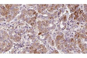 ABIN6272365 at 1/100 staining Human liver cancer tissue by IHC-P. (NMUR1 anticorps  (N-Term))