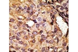 IHC analysis of FFPE human breast carcinoma tissue stained with the TLR6 antibody