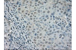 Immunohistochemical staining of paraffin-embedded Adenocarcinoma of ovary tissue using anti-DHFRmouse monoclonal antibody. (Dihydrofolate Reductase anticorps)