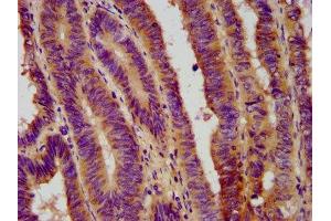 IHC image of ABIN7152698 diluted at 1:800 and staining in paraffin-embedded human colon cancer performed on a Leica BondTM system. (FERMT1 anticorps  (AA 321-420))
