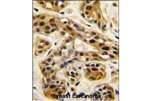 Formalin-fixed and paraffin-embedded human breast carcinoma tissue reacted with PRMT1 antibody (C-term ), which was peroxidase-conjugated to the secondary antibody, followed by DAB staining. (PRMT1 anticorps  (C-Term))