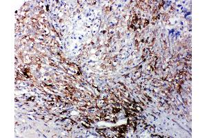 Anti-LTBR antibody, IHC(P) IHC(P): Human Intestinal Cancer Tissue (LTBR anticorps  (C-Term))