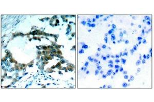 Immunohistochemical analysis of paraffin-embedded human lung carcinoma tissue using PKCth(Phospho-Ser695) Antibody(left) or the same antibody preincubated with blocking peptide(right).