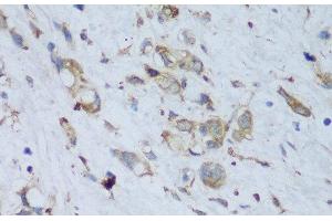 Immunohistochemistry of paraffin-embedded Human gastric cancer using ENPP3 Polyclonal Antibody at dilution of 1:150 (40x lens). (ENPP3 anticorps)