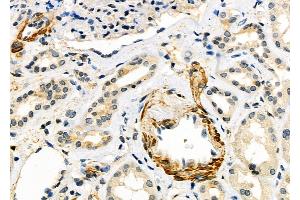 ABIN6259876 and ABIN6279101 at 1/100 staining Human kidney cancer and adjacent normal tissues by IHC-P.