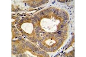TRPM8 antibody immunohistochemistry analysis in formalin fixed and paraffin embedded human prostate carcinoma.