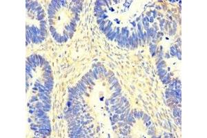 Immunohistochemistry of paraffin-embedded human ovarian cancer using ABIN7163155 at dilution of 1:100 (SACM1L anticorps  (AA 301-520))