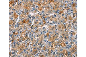 Immunohistochemistry of Human liver cancer using BCL10 Polyclonal Antibody at dilution of 1:40 (BCL10 anticorps)