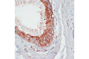 Immunohistochemistry of paraffin-embedded human mammary cancer using PGK2 antibody (ABIN6128431, ABIN6145506, ABIN6145507 and ABIN6216775) at dilution of 1:100 (40x lens). (PGK2 anticorps  (AA 242-360))