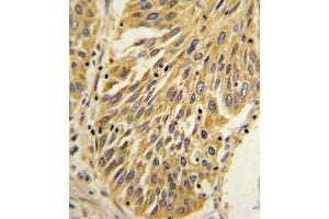 Formalin-fixed and paraffin-embedded human lung carcinoma with IL1B Antibody (Center), which was peroxidase-conjugated to the secondary antibody, followed by DAB staining.