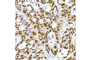 Immunohistochemistry of paraffin-embedded human colon carcinoma using DNA-PKcs Rabbit mAb (ABIN7269665) at dilution of 1:100 (40x lens). (PRKDC anticorps)