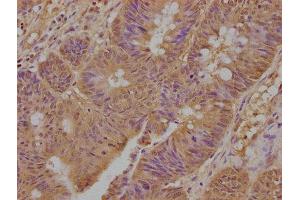 IHC image of ABIN7173872 diluted at 1:300 and staining in paraffin-embedded human colon cancer performed on a Leica BondTM system.