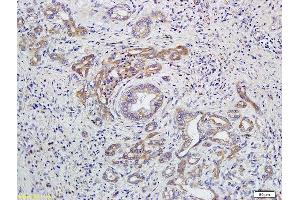 Formalin-fixed and paraffin embedded human colon carcinoma labeled with Anti-GNAQ/Gα q Polyclonal Antibody, Unconjugated  at 1:200 followed by conjugation to the secondary antibody and DAB staining.