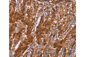 Immunohistochemistry of Human gastric cancer using BRK1 Polyclonal Antibody at dilution of 1:40 (BRK1 anticorps)
