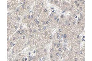 ABIN6267630 at 1/200 staining human liver cancer tissue sections by IHC-P.