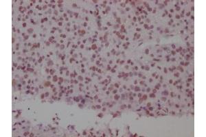 IHC image of ABIN7127813 diluted at 1:100 and staining in paraffin-embedded human glioma cancer performed on a Leica BondTM system.