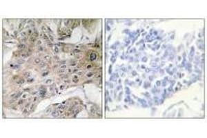 Immunohistochemistry analysis of paraffin-embedded human breast carcinoma tissue using COX7S/A2 antibody. (COX7A2P2 anticorps)