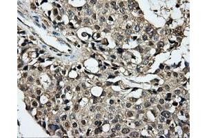 Immunohistochemical staining of paraffin-embedded Adenocarcinoma of breast tissue using anti-PLEK mouse monoclonal antibody. (Pleckstrin anticorps)