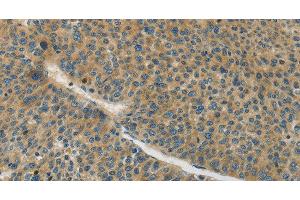 Immunohistochemistry of paraffin-embedded Human liver cancer tissue using Connexin-45 Polyclonal Antibody at dilution 1:50 (GJC1 anticorps)
