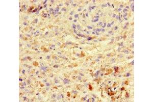 Immunohistochemistry of paraffin-embedded human melanoma using ABIN7172419 at dilution of 1:100 (VGLL4 anticorps  (AA 43-277))